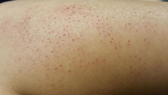 朋友皮肤用过脱毛膏后泛红 有刺痛感 并且毛孔出现小点 这是什么情况