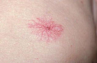 蜘蛛痣是什么症状?