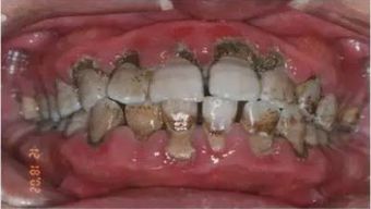 牙结石的危害是什么