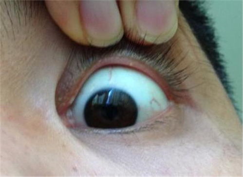 眼睑上长小颗粒为什么