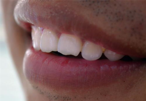 什么是后槽牙呢?