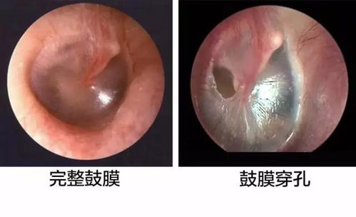 耳膜破了怎么办?.