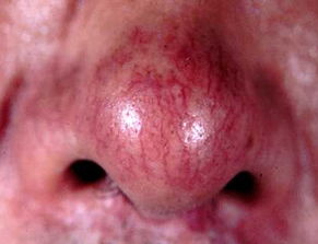 酒糟鼻后期鼻赘如何修复?