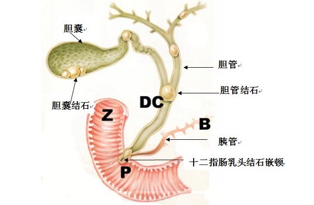 排胆结石的方法