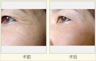 去皱纹哪里好?我真的不太了解。