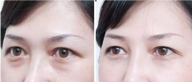 怎样才能消除眼袋?