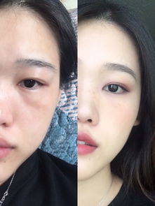 哭过后眼睛消肿最快的方法?