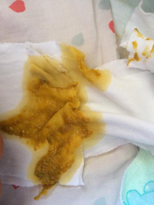 婴儿拉稀屎怎么办