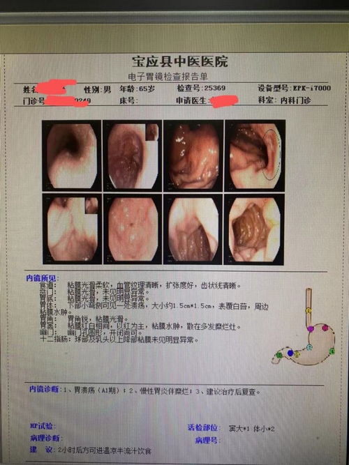 幽门螺杆菌的检测指标正常值是多少,具体