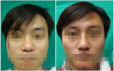 男生隆鼻跟女生有区别吗?