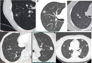 右肺上叶小结节是什么意思?