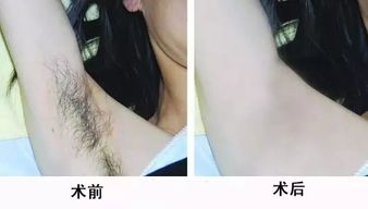 哪种激光脱毛效果好?