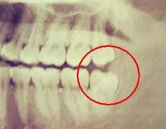 长智齿预示着什么运势,长智齿预示未来好吗