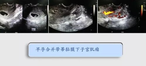 什么是粘膜下子宫肌瘤