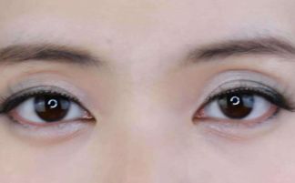 眼睛肿是什么原因引起