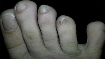 请问,我小脚趾的指甲只有一点点,还特丑,如果我把它剪掉了大部分,只留