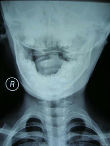 寰枢椎半脱位是什么?