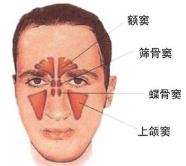 鼻炎和鼻窦炎是一回事儿吗?怎么区分它们?