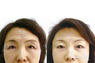 额头上抬头纹多怎么办