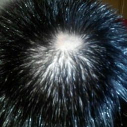 头顶右侧头皮疼,而且摸头发头皮就疼是什么原因?