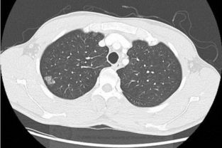 肺部有结节是怎么回事