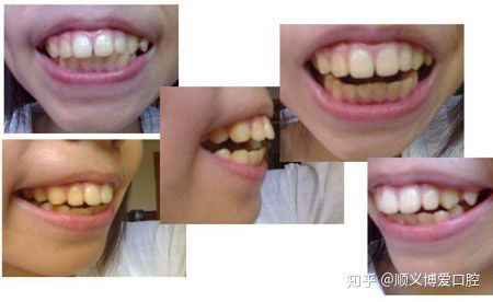 合肥龅牙矫正一般多少钱?24岁了,有知道的吗