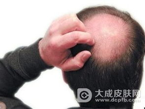 怎么才能减少掉头发