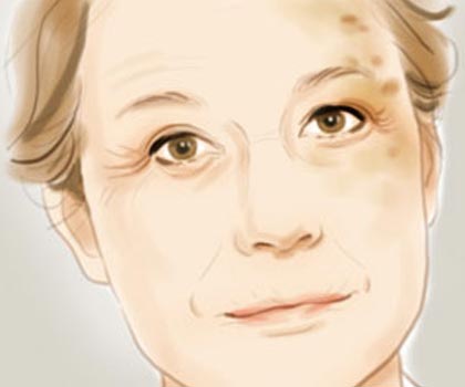 去除老年斑最好最快的方法