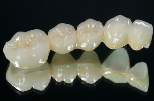 做一颗全瓷牙需要多少钱?