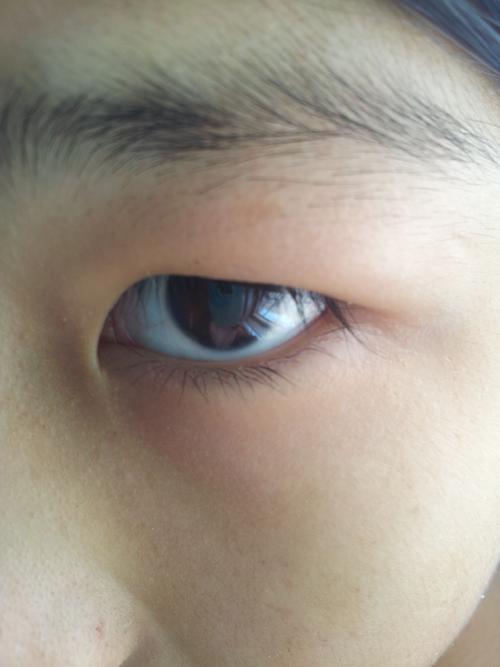 化妆眼睛肿了怎么办