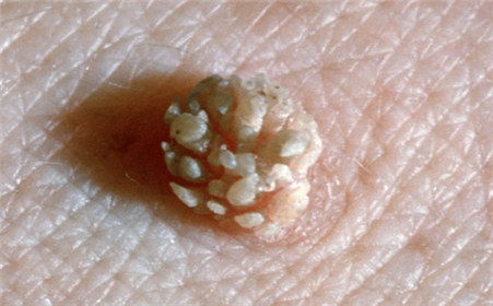 哪些细思极恐的行为会让你感染HPV?感染HPV后该怎么办?