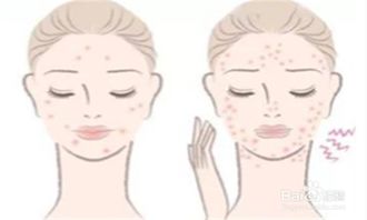 生活中多吃什么东西 可以避免长痘痘