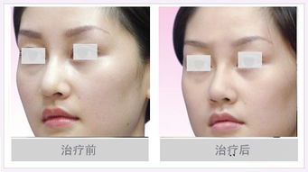 鼻头缩小手术怎么做的