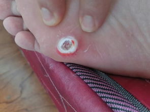 怎么正确用鸡眼膏,用完怎么处理鸡眼