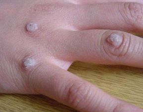 关于皮肤赘生物描述不对是?