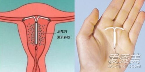 小越卫生院上环多少钱?