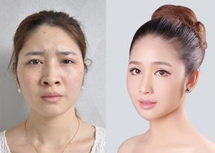 鼻孔被扣大了怎么办,怎么缩小