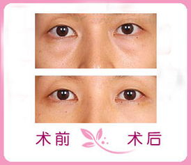 去眼袋的手术费是多少