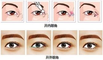 开眼角手术一般需要多少钱