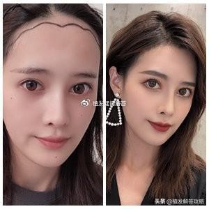美人尖是什么意思