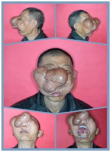 胎儿腭部指的是哪里?腭部的疾病又有哪些呢?