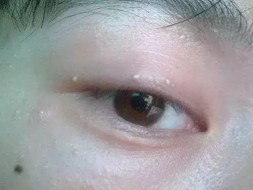 眼睛旁边的脂肪粒怎么消除
