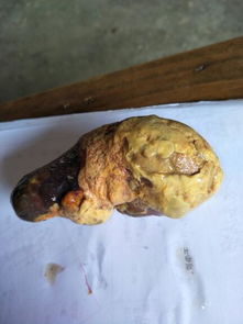 睾丸有硬块是什么原因