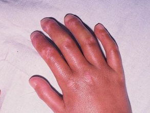 包茎手术费用多少?