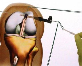 膝盖积水是怎么回事?