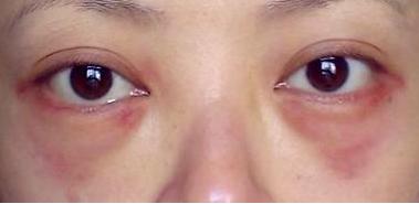 切除眼袋的方法?