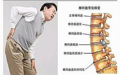 腰椎间盘突出怎么锻炼比较好?