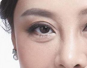 眼皮松弛怎么办,三种方法可以解决