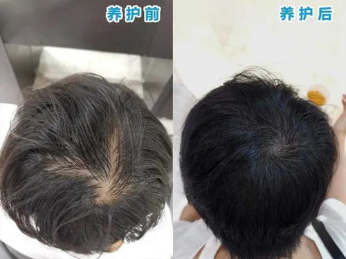 脂溢性脱发能治疗吗?能否给提供比较好的治疗方法?