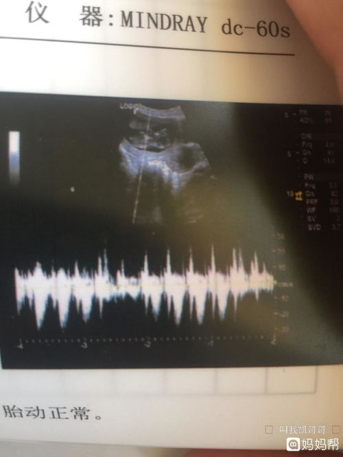 nub是什么意思 nub是胎儿未发育成熟的生殖器官对吗